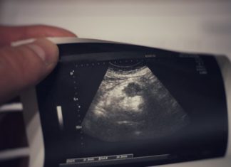 Ο καρκίνος στο πάγκρεας μπορεί να θεραπευθεί υπό προϋποθέσεις