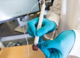 Xειρουργικό πενάκι διακρίνει με ακρίβεια τον υγιή από τον καρκινικό ιστό